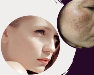 Trị Nám Bằng Laser Toning