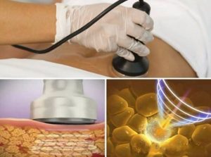 Sóng siêu âm là gì? Giảm béo bằng sóng siêu âm có hại không? 5 Sóng siêu âm rất an toàn và hiệu quả