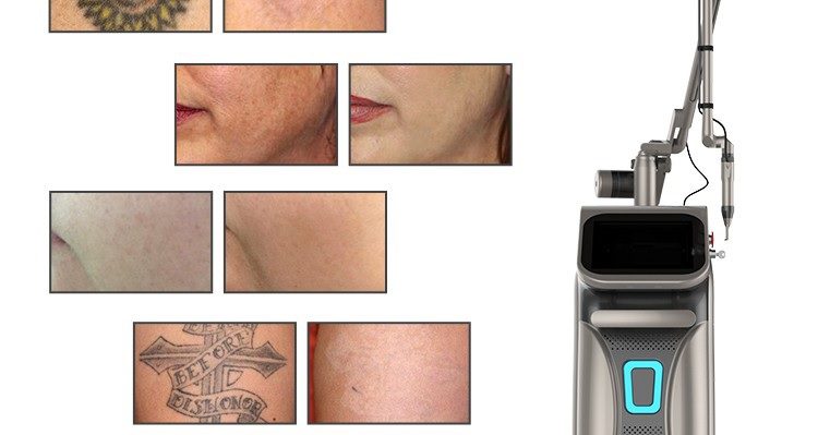 may-laser-picotech-gold-2021-2