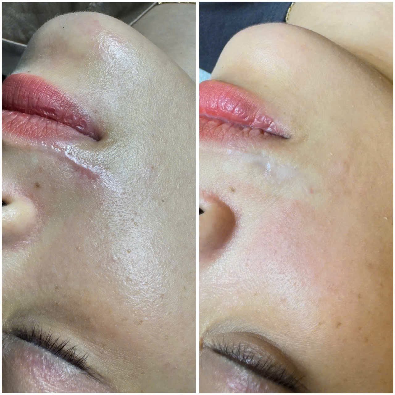Điều trị sẹo rỗ: Vì sao không có một công nghệ nào phù hợp cho mọi trường hợp? 2 Điều Trị Sẹo Bằng Công Nghệ Laser Fractional CO2 Sau 3 Lần