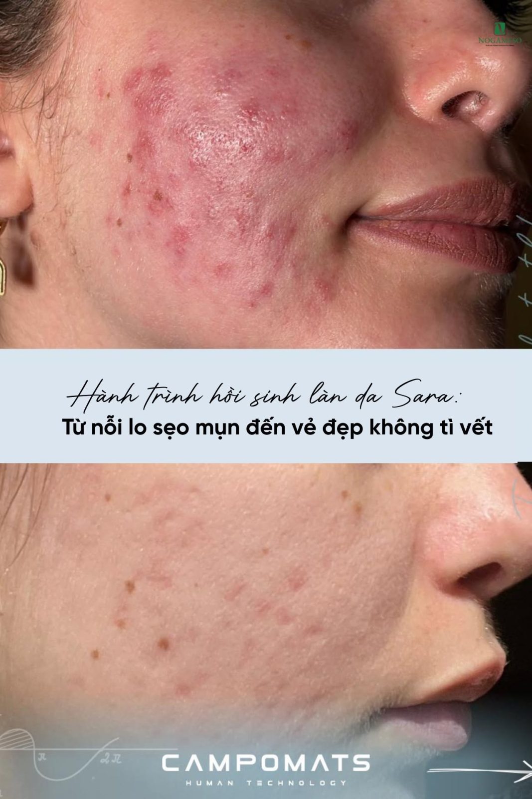 Điều trị sẹo rỗ: Vì sao không có một công nghệ nào phù hợp cho mọi trường hợp? 3 Điều Trị Sẹo Bằng Công Nghệ Microneedling