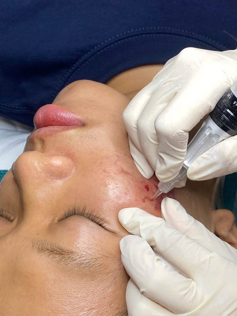 Điều trị sẹo rỗ: Vì sao không có một công nghệ nào phù hợp cho mọi trường hợp? 4 Điều Trị Sẹo Bằng Microneedling