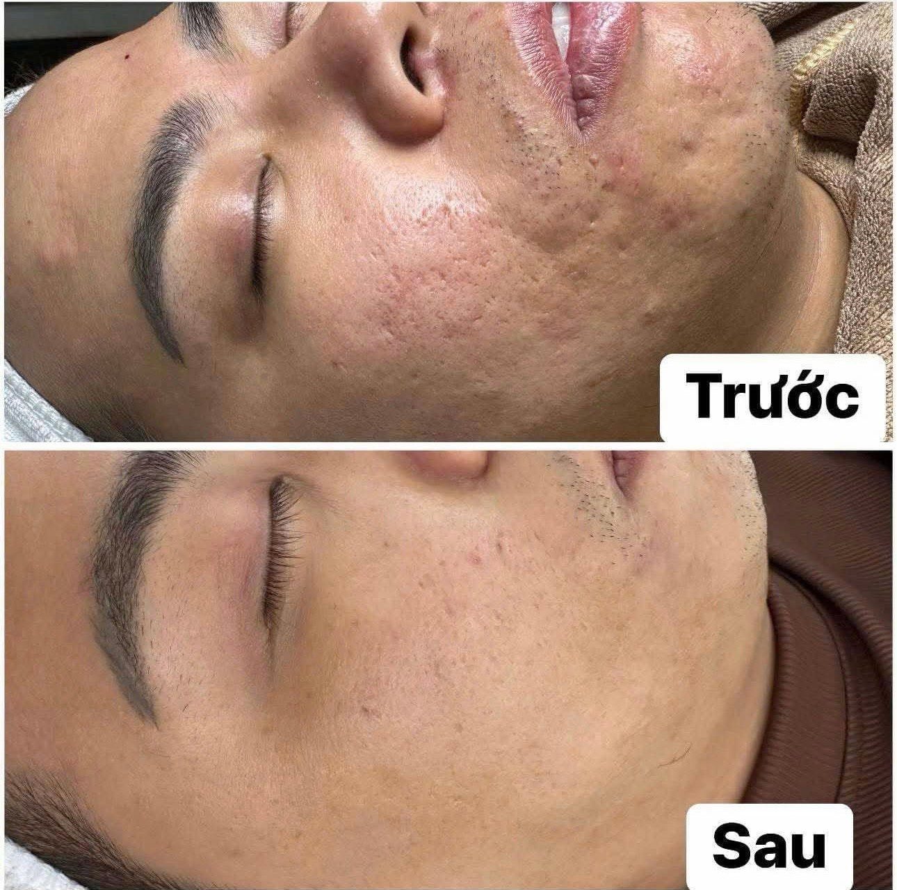 Điều trị sẹo rỗ: Vì sao không có một công nghệ nào phù hợp cho mọi trường hợp? 1 Điều Trị Sẹo Rỗ Bằng Công Nghệ Laser Fractional CO2