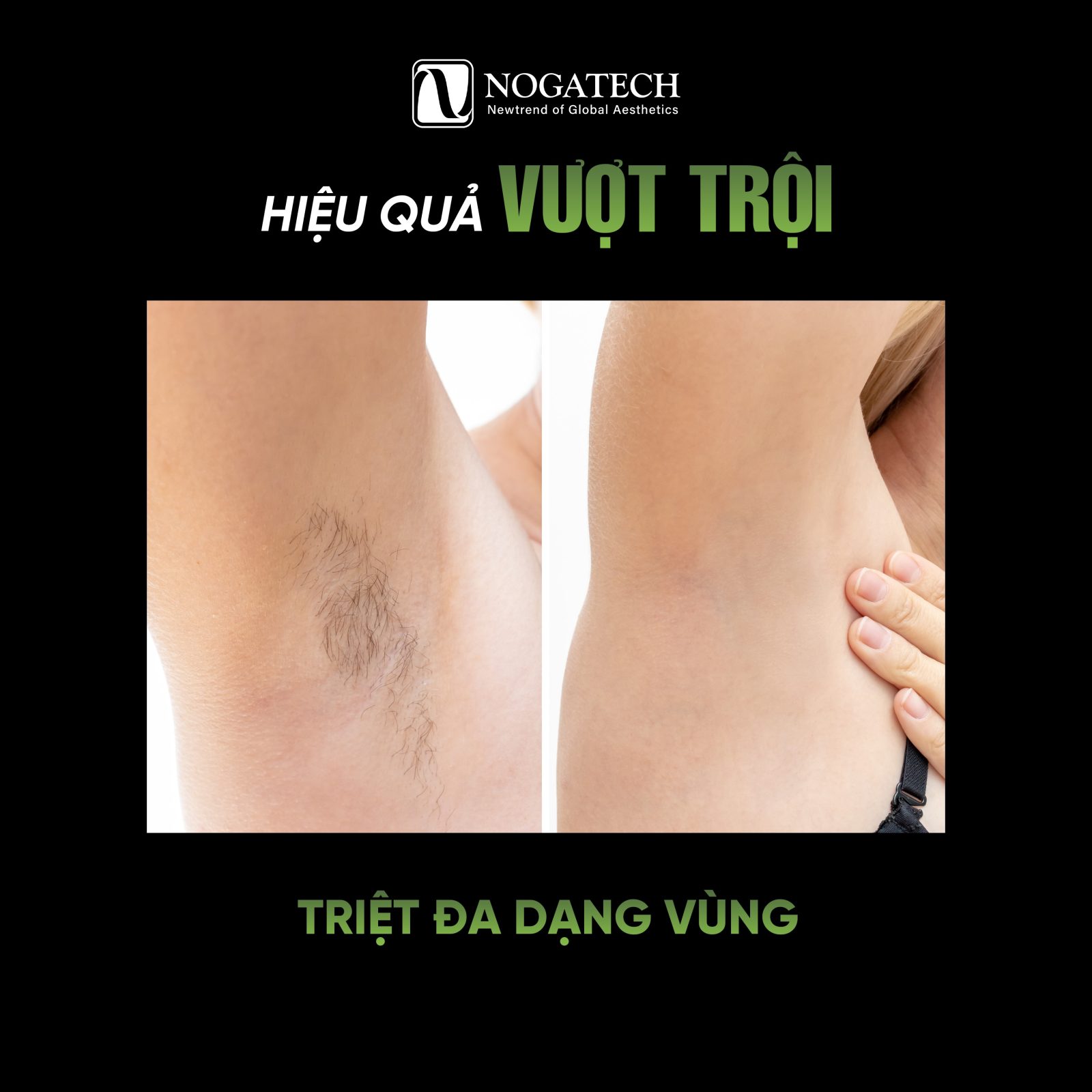 Hiệu Quả Máy Triệt Lông Diode Laser HEDIOS