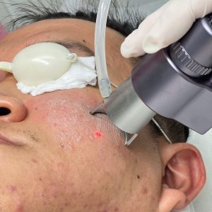 Laser CO2 Fractional - Điều Trị Sẹo