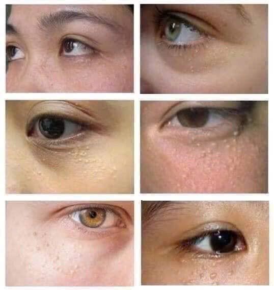 Laser CO2 Fractional: Khi nào Clinic nên đầu tư và lựa chọn thiết bị như thế nào? 3 Laser CO2 Fractional - Phác Đồ Điều Trị Mụn Dưới Mắt