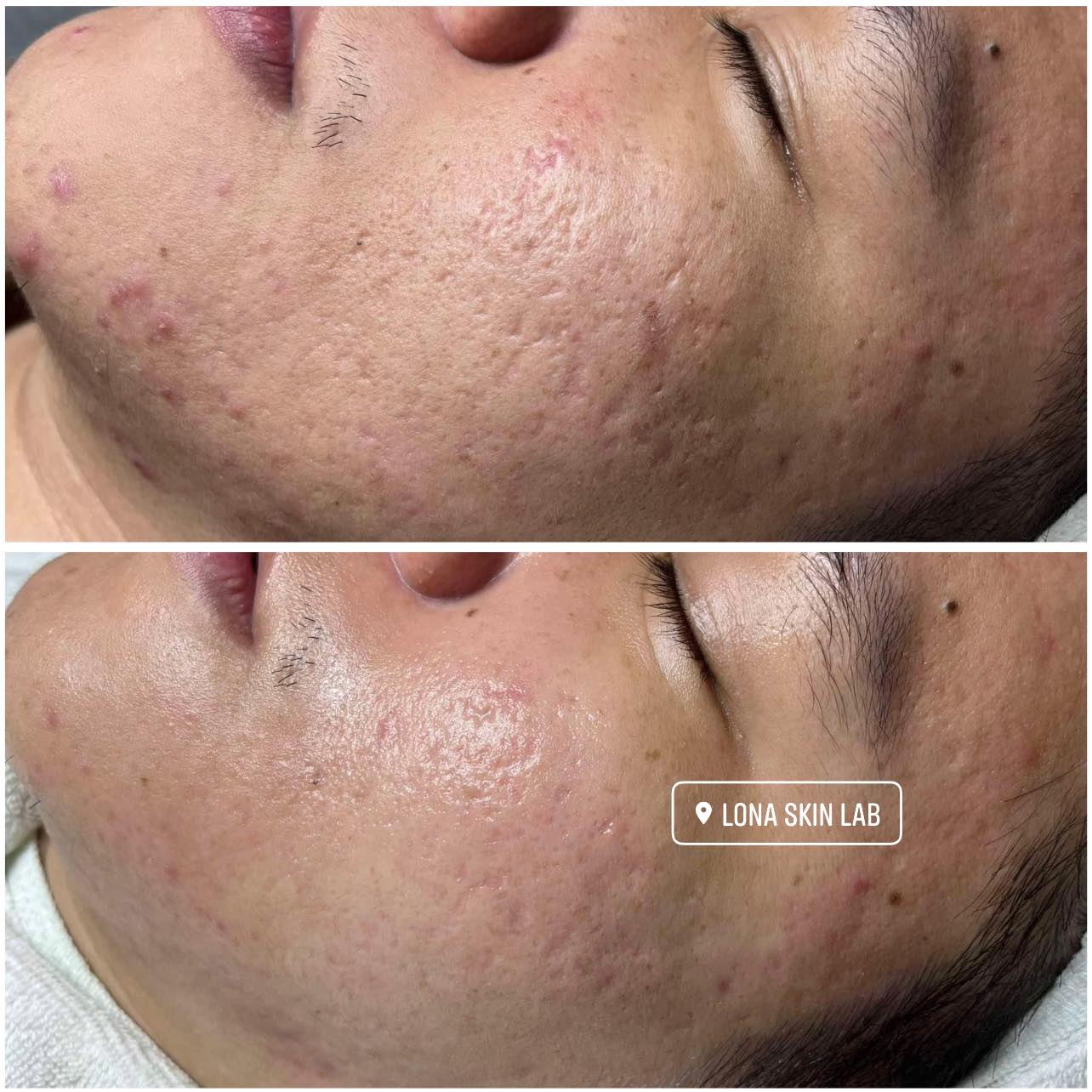 Laser CO2 Fractional: Khi nào Clinic nên đầu tư và lựa chọn thiết bị như thế nào? 2 Laser CO2 Fractional - Phác Đồ Điều Trị Sẹo Rỗ