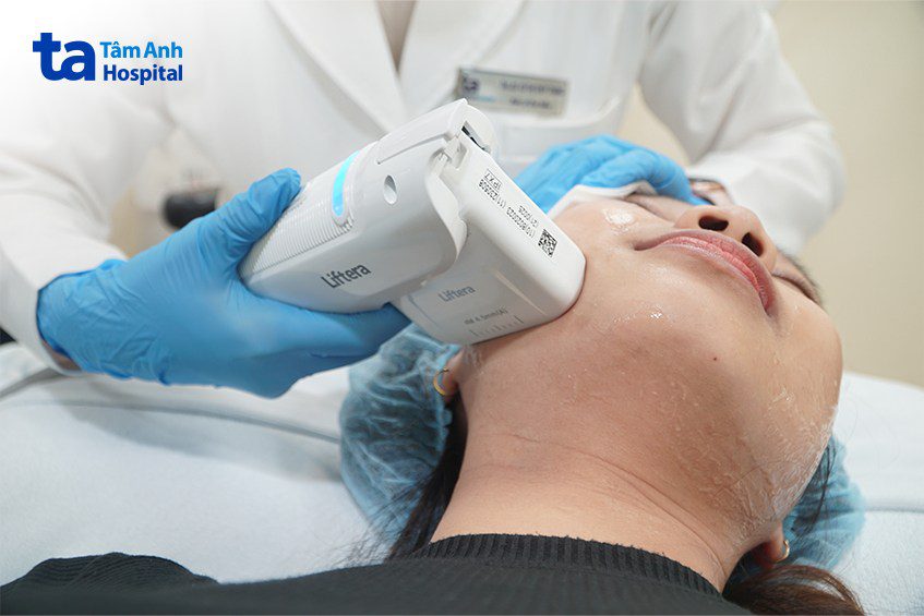 Nâng Cơ Hifu Liftera tại Bệnh Viện Tâm Anh