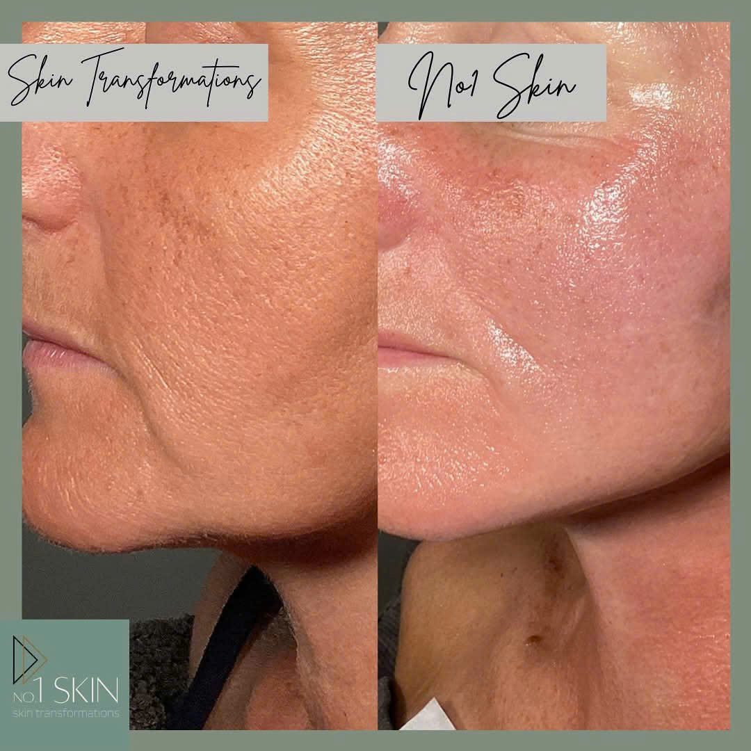 Phục Hồi Da Bằng Công Nghệ Microneedling