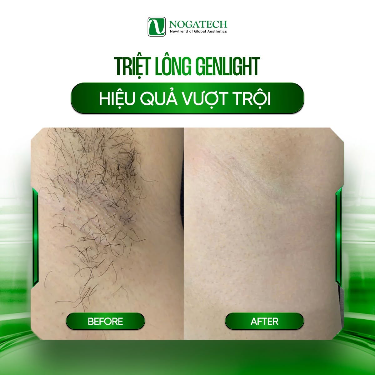 Máy triệt lông Gentlight - Đa bước sóng 4 Trước và Sau - Máy triệt lông Gentlight